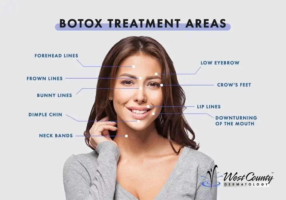 Botox treatment areas